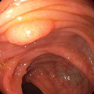 Darmpolyp | Tubuläres Adenom Kolon